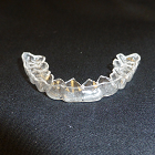 Essix Retainer