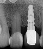 Dental Implants